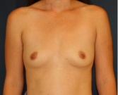 Feel Beautiful - Breast Augmentation 135 - Before Photo